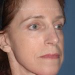 Upper & Lower Facelift - Brow Lift & Face/Neck Lift Before & After Patient #2642