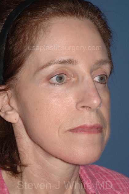 Facelift - Face/Neck (Lower) Before & After Patient #2642