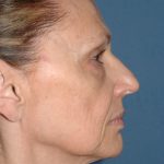 Upper & Lower Facelift - Brow Lift & Face/Neck Lift Before & After Patient #2640