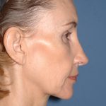 Upper & Lower Facelift - Brow Lift & Face/Neck Lift Before & After Patient #2639