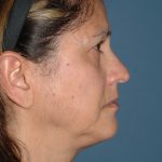Upper & Lower Facelift - Brow Lift & Face/Neck Lift Before & After Patient #2638