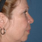 Upper & Lower Facelift - Brow Lift & Face/Neck Lift Before & After Patient #2641