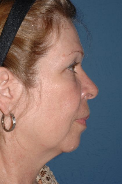 Facelift - Face/Neck (Lower) Before & After Patient #2641