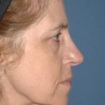 Upper & Lower Facelift - Brow Lift & Face/Neck Lift Before & After Patient #2642