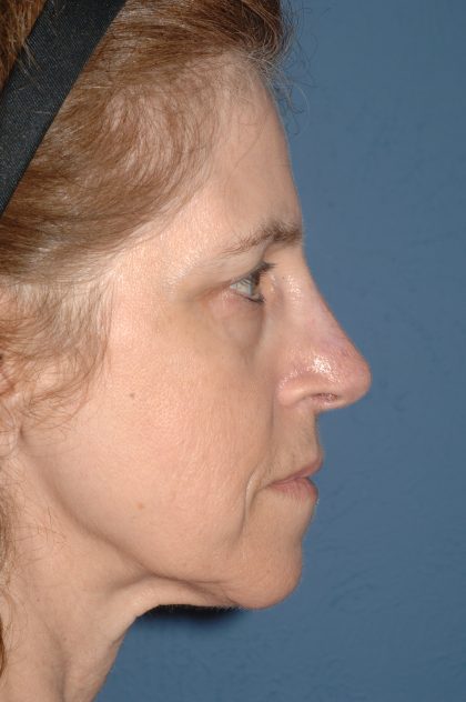 Facelift - Face/Neck (Lower) Before & After Patient #2642