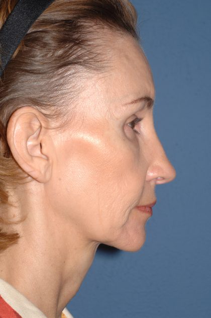 Facelift - Face/Neck (Lower) Before & After Patient #2639