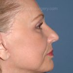 Upper & Lower Facelift - Brow Lift & Face/Neck Lift Before & After Patient #2640