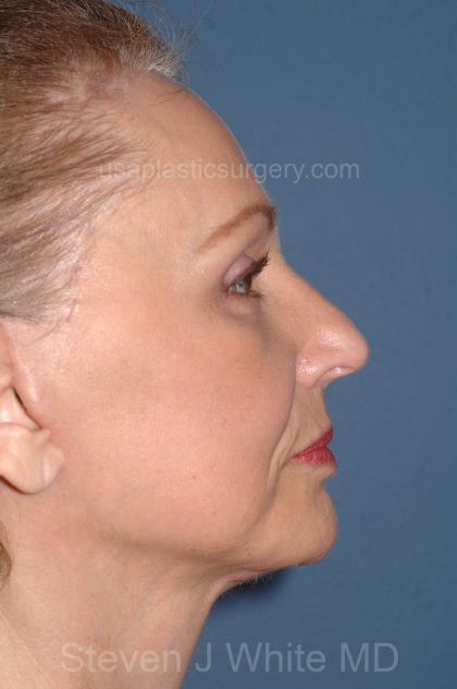 Facelift - Face/Neck (Lower) Before & After Patient #2640