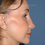 Upper & Lower Facelift - Brow Lift & Face/Neck Lift Before & After Patient #2639