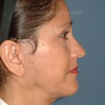 Upper & Lower Facelift - Brow Lift & Face/Neck Lift Before & After Patient #2638