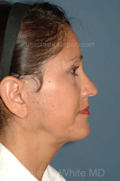 Facelift - Face/Neck (Lower) Before & After Patient #2638