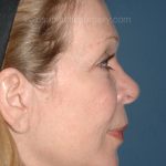 Upper & Lower Facelift - Brow Lift & Face/Neck Lift Before & After Patient #2641