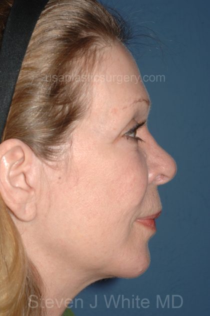 Facelift - Face/Neck (Lower) Before & After Patient #2641