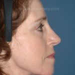 Upper & Lower Facelift - Brow Lift & Face/Neck Lift Before & After Patient #2642