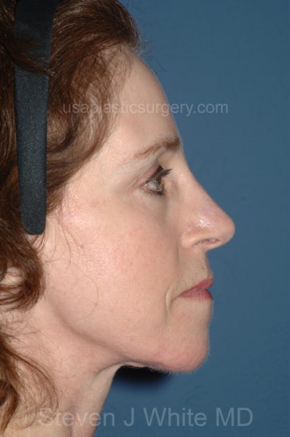 Facelift - Face/Neck (Lower) Before & After Patient #2642