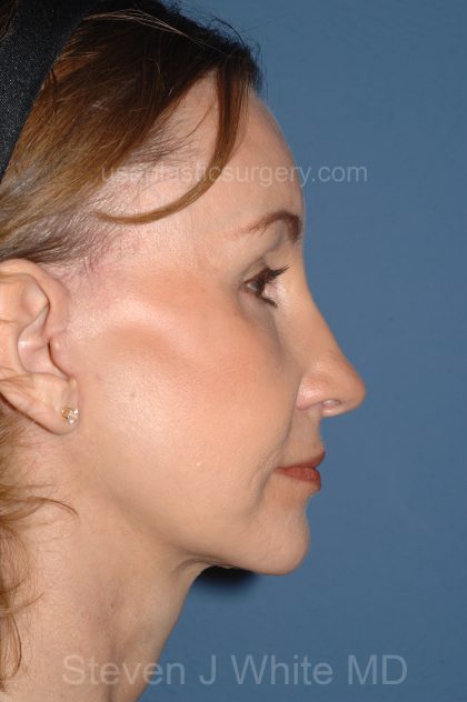 Facelift - Face/Neck (Lower) Before & After Patient #2639