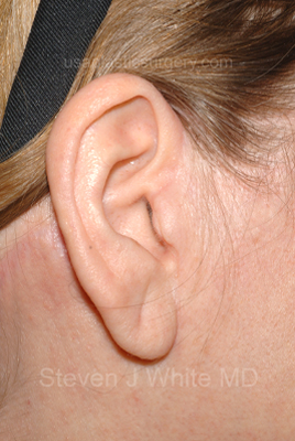 Facelift - Face/Neck (Lower) Before & After Patient #2641