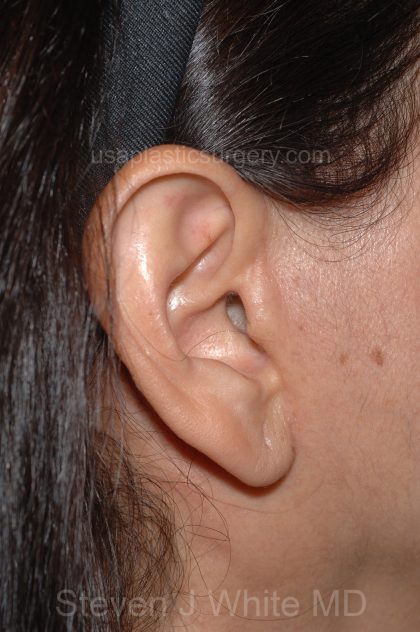 Facelift - Face/Neck (Lower) Before & After Patient #2638