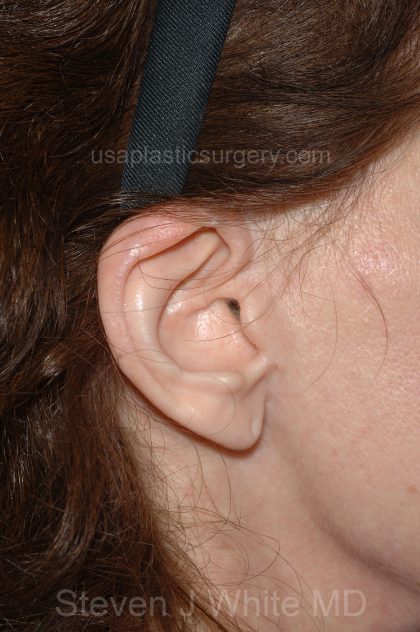Facelift - Face/Neck (Lower) Before & After Patient #2642