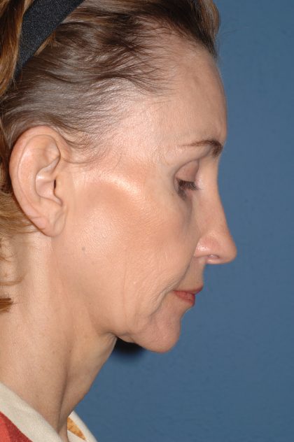 Facelift - Face/Neck (Lower) Before & After Patient #2639