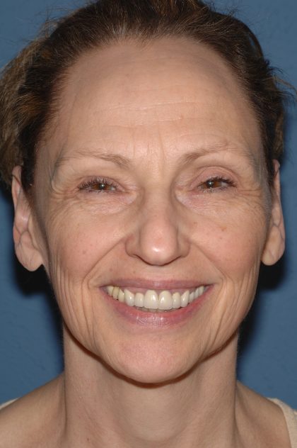 Facelift - Face/Neck (Lower) Before & After Patient #2640