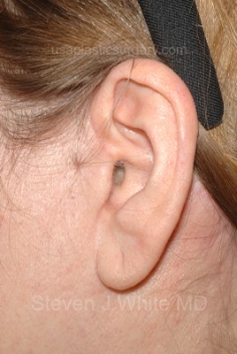 Facelift - Face/Neck (Lower) Before & After Patient #2641