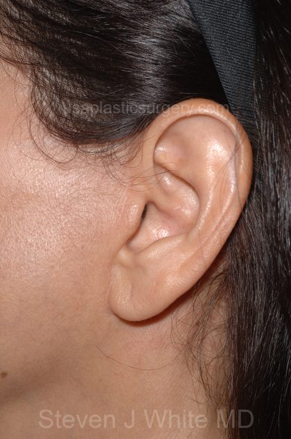 Facelift - Face/Neck (Lower) Before & After Patient #2638