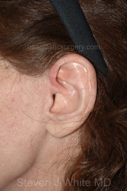 Facelift - Face/Neck (Lower) Before & After Patient #2642