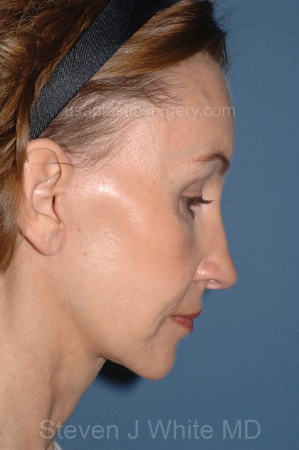 Facelift - Face/Neck (Lower) Before & After Patient #2639