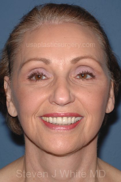 Facelift - Face/Neck (Lower) Before & After Patient #2640