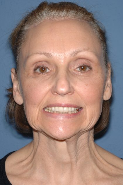 Facelift - Face/Neck (Lower) Before & After Patient #2640