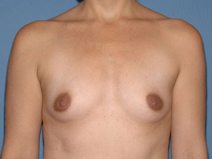 Breast Implants - Breast Augmentation Before & After Patient #2904