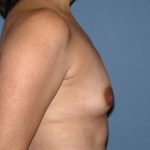 Breast Implants - Breast Augmentation Before & After Patient #2904