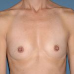 Breast Implants - Breast Augmentation Before & After Patient #2905