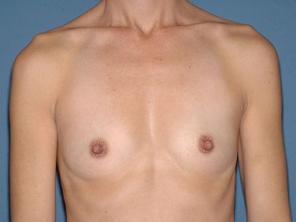 Breast Implants - Breast Augmentation Before & After Patient #2905