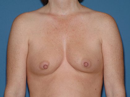 Breast Implants - Breast Augmentation Before & After Patient #2902