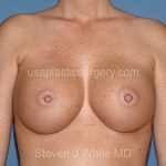 Breast Implants - Breast Augmentation Before & After Patient #2902