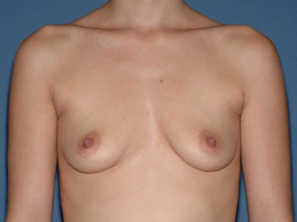 Breast Implants - Breast Augmentation Before & After Patient #2900