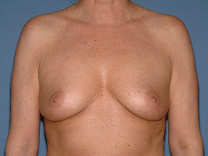 Breast Implants - Breast Augmentation Before & After Patient #2899
