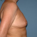 Breast Implants - Breast Augmentation Before & After Patient #2899