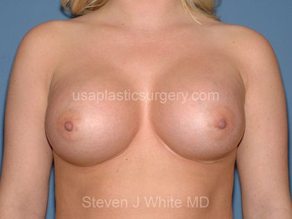 Breast Implants - Breast Augmentation Before & After Patient #2898