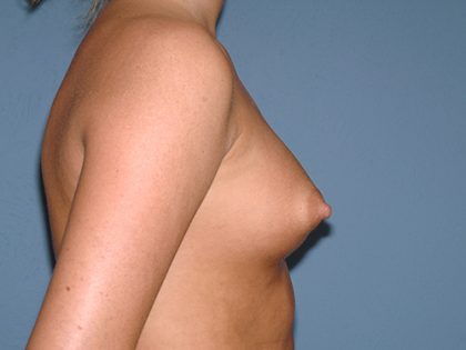 Breast Implants - Breast Augmentation Before & After Patient #2898