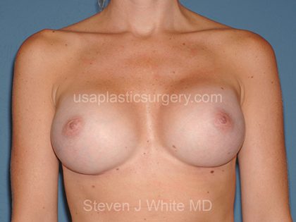 Breast Implants - Breast Augmentation Before & After Patient #2896