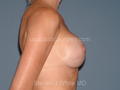 Breast Implants - Breast Augmentation Before & After Patient #2896
