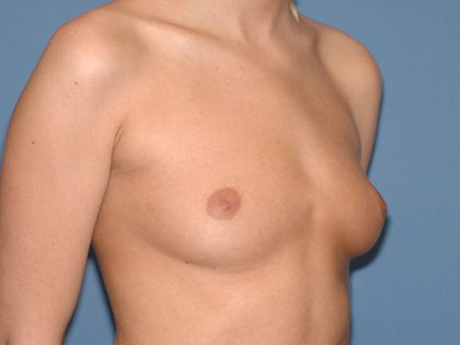 Breast Implants - Breast Augmentation Before & After Patient #2895
