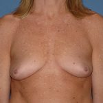Breast Implants - Breast Augmentation Before & After Patient #2894
