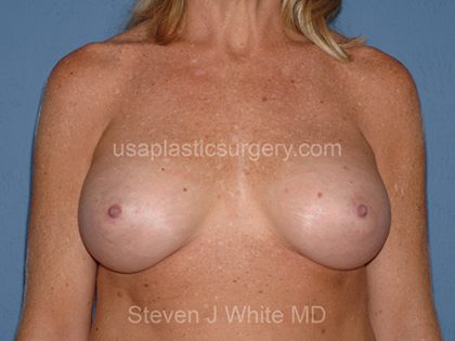 Breast Implants - Breast Augmentation Before & After Patient #2894