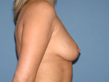Breast Implants - Breast Augmentation Before & After Patient #2893