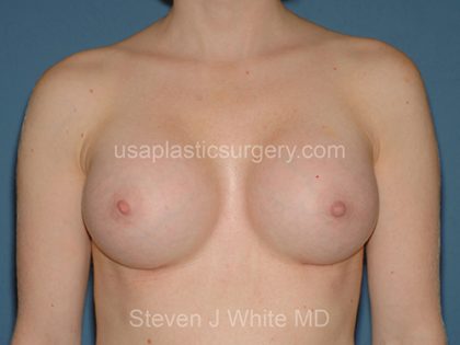 Breast Implants - Breast Augmentation Before & After Patient #2830