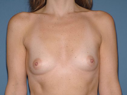 Breast Implants - Breast Augmentation Before & After Patient #2828